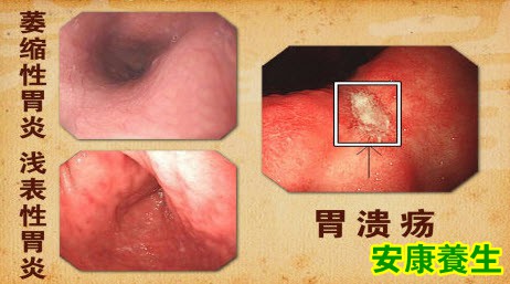 养生堂20131228视频和笔记:苏向前讲胃癌的癌前病变,胃炎,胃溃疡,息肉