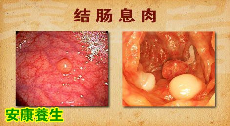 肠道息肉，肠炎与肠癌的关系