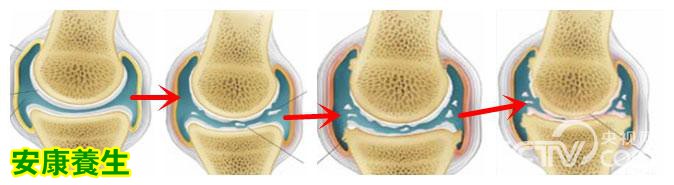 膝关节骨关节炎逐渐发展的模式图
