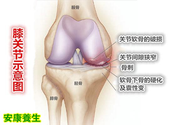 膝关节部位的骨关节炎示意图
