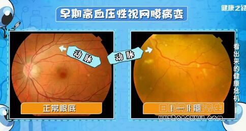 《健康之路》20190227《看出来的健康危机》糖尿病,高血压