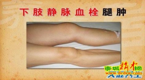 《养生堂》20130607 许俊堂：