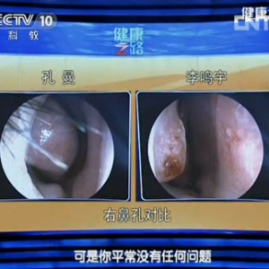 《健康之路》视频和笔记:周兵讲鼻子,鼻塞,鼻梁,嗅觉,鼻中隔