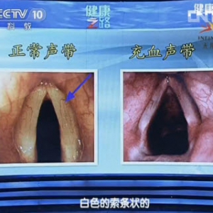《健康之路》视频和笔记:徐振明讲健康好声音 声带 变声期 用嗓过度