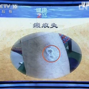 《健康之路》视频:程凯讲胃寒 瘢痕灸 胃胀 滑肉门 艾灸