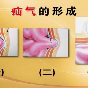 《养生堂》视频鲁纯智:疝气的形成 原因 高危人群 诱发腹压增高