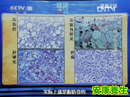脂肪肝