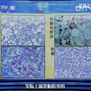 《健康之路》20130924视频:贾继东讲导致脂肪肝最常见的原因 危害 脂肪肝为何会变肝癌