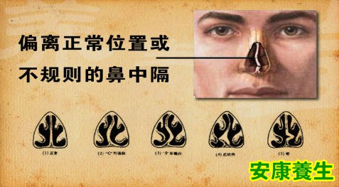 鼻中隔偏曲