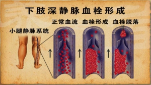 《养生堂》20130302视频:王辰讲肺栓塞的症状和猝死、哪些人需要小心肺栓塞、肺栓塞的早期  ...