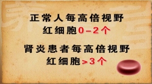 《养生堂》20130228视频:聂莉芳讲感冒和肾病的关系、肾病的常见症状、血尿的检测判定标准  ...