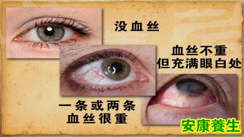 眼底血丝