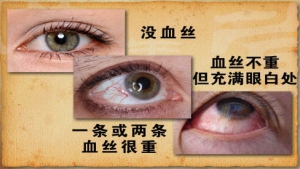 《养生堂》20130218视频:王宏宇讲血管老化、眼底出血、心绞痛和血管健康的关联、饮食调节  ...