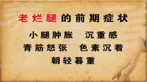 《养生堂》20130205视频:董建勋讲静脉曲张、老烂腿的前期症状、危害、坐姿和血液循环的关  ...