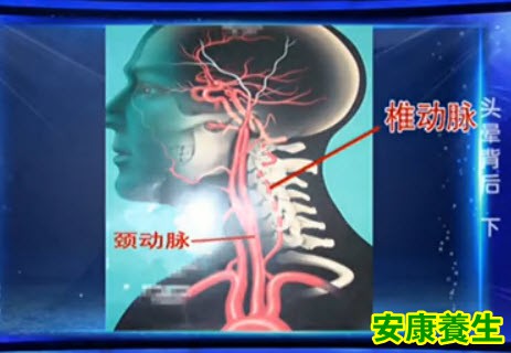 颈动脉狭窄