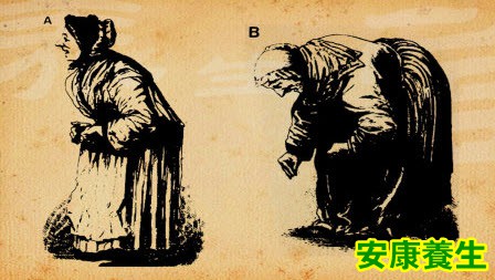 帕金森病