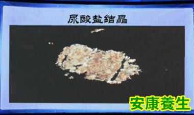 痛风石