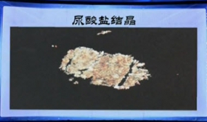 《健康之路》20131021视频:刘湘源讲痛风高危人群，尿酸高是痛风吗、痛风发作时多数从哪 .. ...