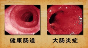 北京卫视20131122《养生堂》视频:王化虹 张谦讲免疫系统、肠道菌群、肠道年龄、膳食纤维