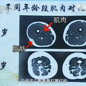 《健康之路》20131126视频:陈伟讲肌肉减少症、哪种食物有助于长肌肉、预防老年人摔倒