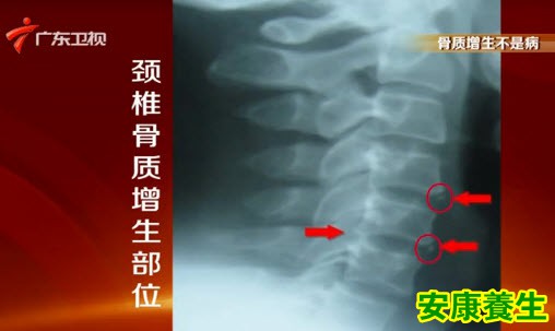 骨质增生