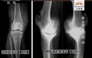 《健康之路》20131128视频:寇伯龙讲肥胖带来的膝关节问题、膝关节肌肉锻炼操、保护膝关节  ...