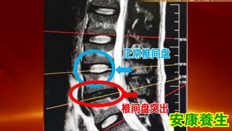 腰椎间盘突出
