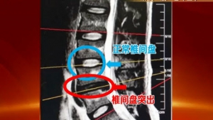 健康有道20131128视频:沈彤讲什么是腰椎间盘突出、解决腰害、如何自查腰椎间盘突出