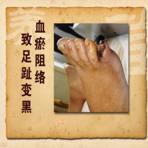 《养生堂》20131212视频和笔记:吕培文讲血瘀阻络,首乌藤,寒湿阻络,首乌藤洗剂,首乌藤粥