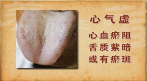 《养生堂》20131224视频:于作洋讲心气不足,心气虚,心火虚,舌象,补益心气茶,补益清心茶