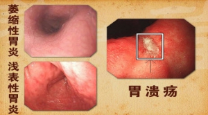 《养生堂》20131228视频和笔记:苏向前讲胃癌的癌前病变,胃炎,胃溃疡,息肉