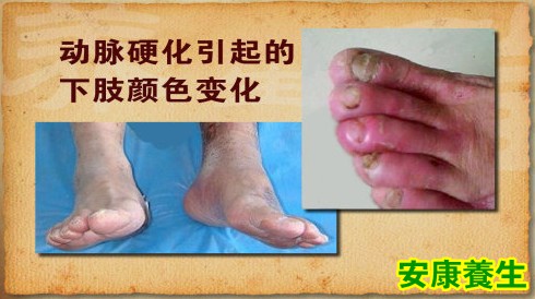 下肢青紫、坏死