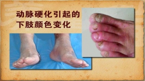 《养生堂》20131231视频和笔记:王正义讲八字脚,间歇性跛行,腰椎狭窄