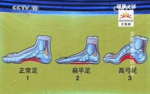 《健康之路》20131220视频和笔记:温建民讲扁平足,高弓足,拇外翻