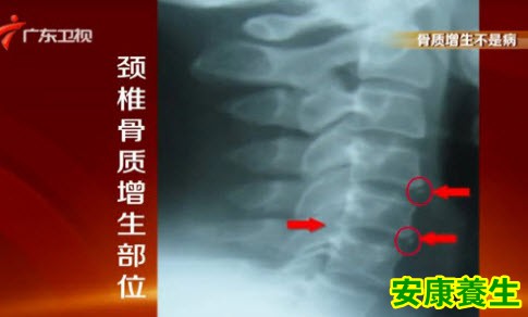 什么是骨质增生