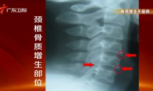 健康有道20140103视频和笔记:沈彤讲骨质增生,骨刺,骨赘,补钙