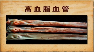 《养生堂》20140118视频和笔记:李建军讲高血脂,冠心病,血脂化验单,斑块