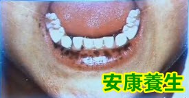 口周黑子病