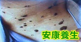 老年斑