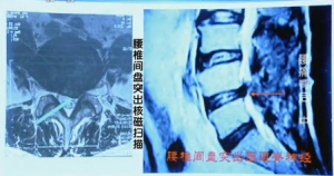 《健康之路》20140311视频笔记:海涌讲《腰疼背后的秘密(中)》腰椎间盘突出