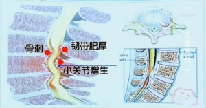 《健康之路》20140312视频和笔记:海涌讲《腰疼背后(下)》腰椎管狭窄,间歇性跛行