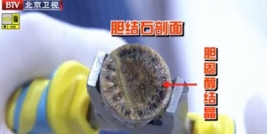 我是大医生20140325视频:《有胆你就看》胆结石,胆囊癌,胆囊炎,甲壳素
