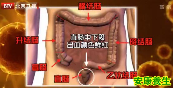结直肠癌