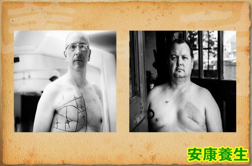 乳房切除