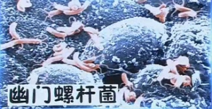《健康之路》20140418视频和笔记:沈琳讲《身边的致癌隐患(上)》辐射导致癌症,预防宫颈癌