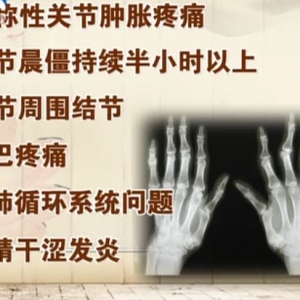 饮食养生汇20140422视频笔记:张春艳讲《类风湿性关节炎的防与护》骨关节炎,类风湿性关 ...