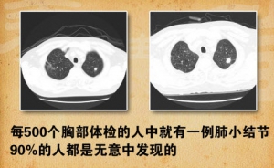 《养生堂》20140425视频笔记:侯生才讲《埋在肺部的定时炸弹-1》肺小结节,肺癌,呼吸道防护