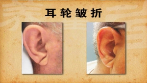 《养生堂》20140430视频和笔记:徐浩讲《吃出来的平衡血脂-3》血脂,耳垂皱折,枸杞鸡汤