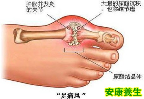 痛风的危害