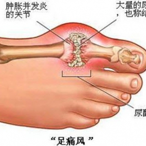 《养生堂》20140504视频笔记:《痛风之痛》痛风的危害,痛风性肾病,高嘌呤饮食,尿毒症